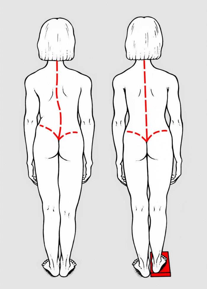 Dismetria ou Síndrome de perna curta